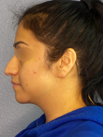Revision Rhinoplasty Before & After Patient #231