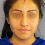 Rhinophyma Before & After Patient #1318