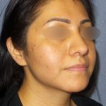 Rhinophyma Before & After Patient #1318