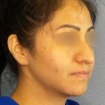 Rhinophyma Before & After Patient #1318
