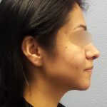 Rhinophyma Before & After Patient #1318