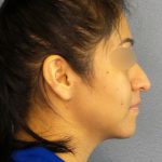 Rhinophyma Before & After Patient #1318