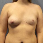 Asymmetric (Uneven) Breasts Before & After Patient #1485