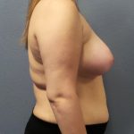 Asymmetric (Uneven) Breasts Before & After Patient #1485