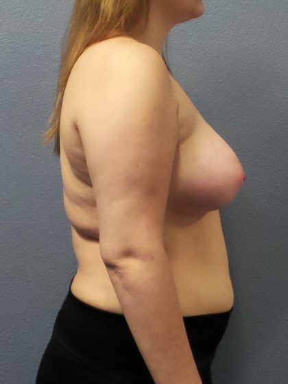 Asymmetric (Uneven) Breasts Before & After Patient #1485