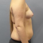 Asymmetric (Uneven) Breasts Before & After Patient #1485