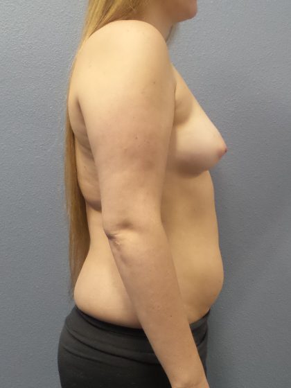 Asymmetric (Uneven) Breasts Before & After Patient #1485