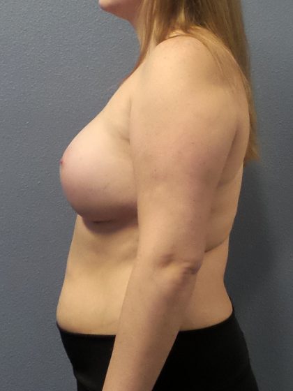 Asymmetric (Uneven) Breasts Before & After Patient #1485
