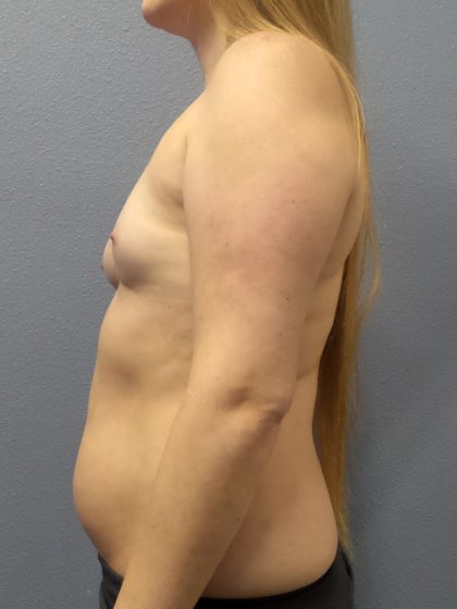 Asymmetric (Uneven) Breasts Before & After Patient #1485