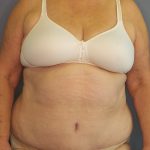 Abdominoplasty Before & After Patient #2042