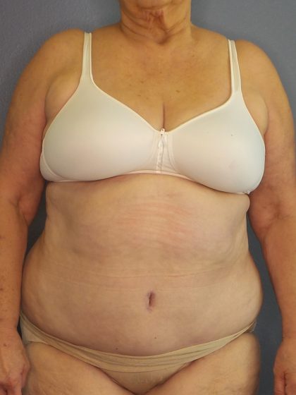 Abdominoplasty Before & After Patient #2042