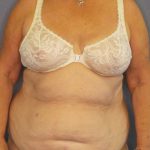 Abdominoplasty Before & After Patient #2042