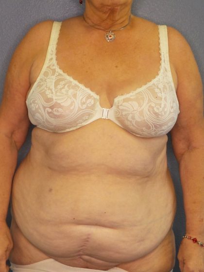 Abdominoplasty Before & After Patient #2042