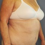Abdominoplasty Before & After Patient #2042