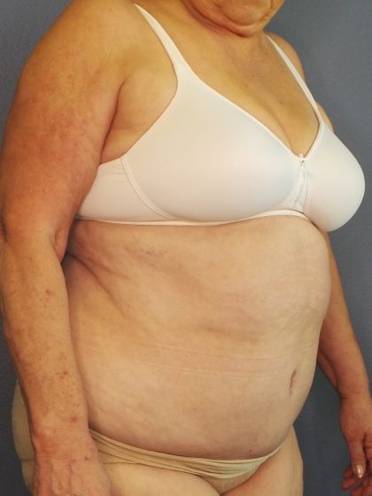 Abdominoplasty Before & After Patient #2042