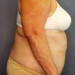 Abdominoplasty Before & After Patient #2042