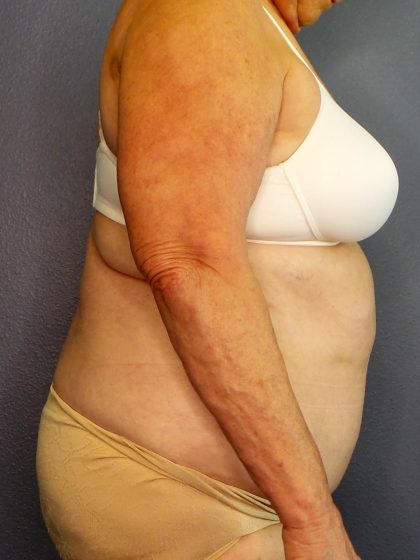 Abdominoplasty Before & After Patient #2042