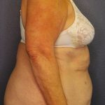 Abdominoplasty Before & After Patient #2042