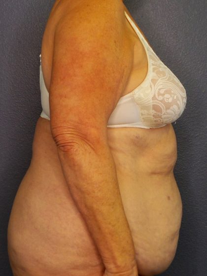 Abdominoplasty Before & After Patient #2042