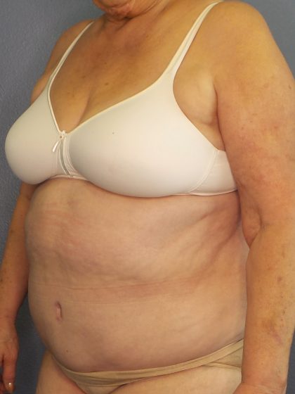 Abdominoplasty Before & After Patient #2042