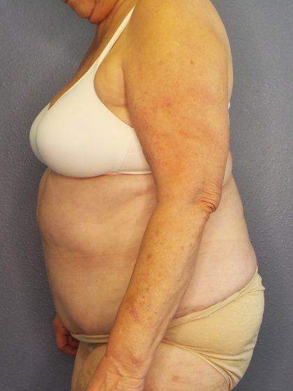 Abdominoplasty Before & After Patient #2042