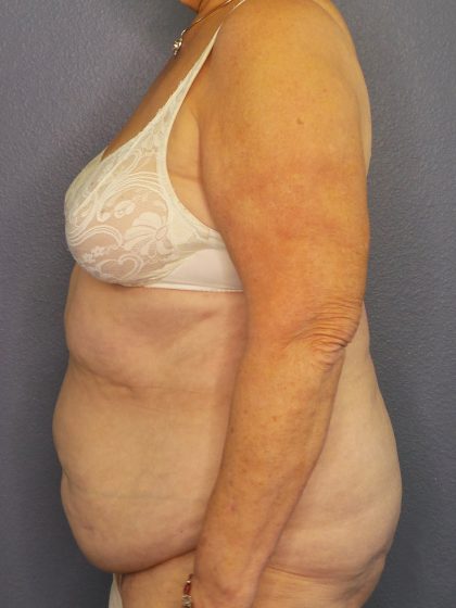 Abdominoplasty Before & After Patient #2042