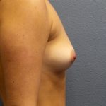 Breast Augmentation Before & After Patient #1752