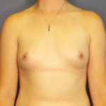 Breast Augmentation Before & After Patient #1640
