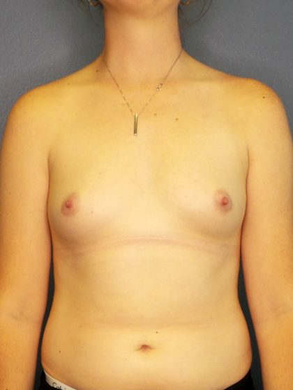 Breast Augmentation Before & After Patient #1640