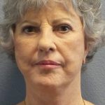Facelift Before & After Patient #852