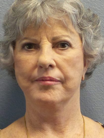 Facelift Before & After Patient #852