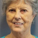 Facelift Before & After Patient #852