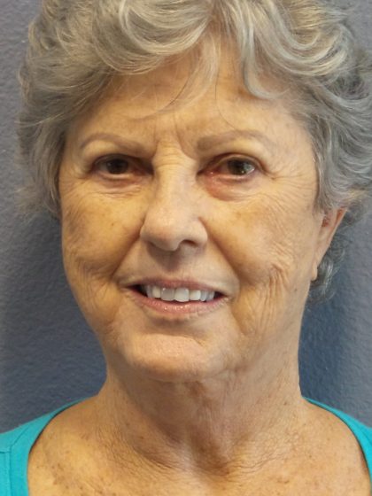 Facelift Before & After Patient #852
