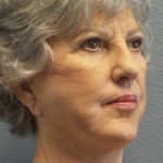 Facelift Before & After Patient #852