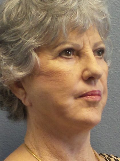 Facelift Before & After Patient #852