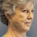 Facelift Before & After Patient #852