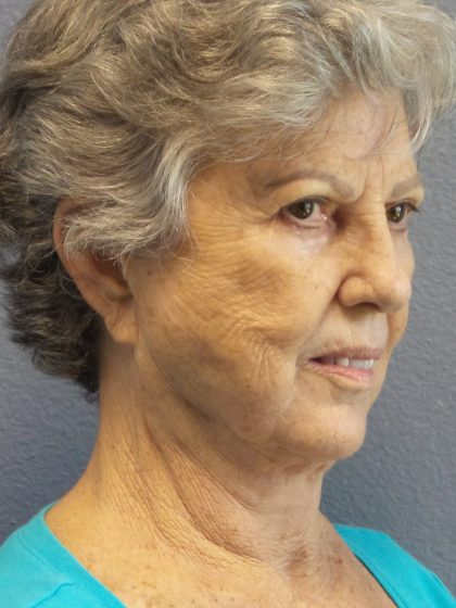 Facelift Before & After Patient #852