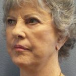 Facelift Before & After Patient #852