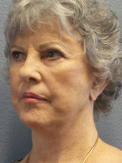 Facelift Before & After Patient #852