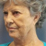 Facelift Before & After Patient #852