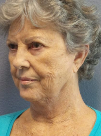 Facelift Before & After Patient #852