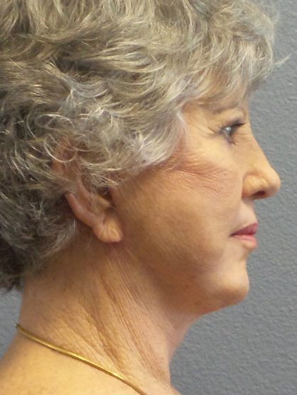 Facelift Before & After Patient #852