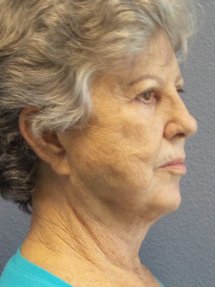 Facelift Before & After Patient #852