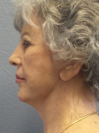 Facelift Before & After Patient #852
