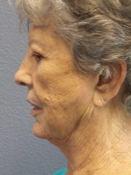 Facelift Before & After Patient #852