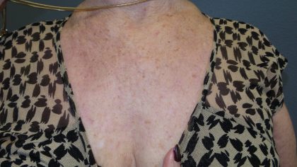 Facelift Before & After Patient #852