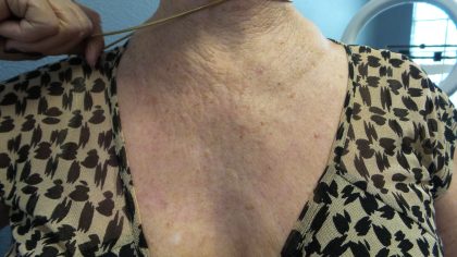 Facelift Before & After Patient #852