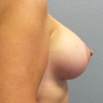 Breast Lift with Implant (Augmentation Mastopexy) Before & After Patient #1016