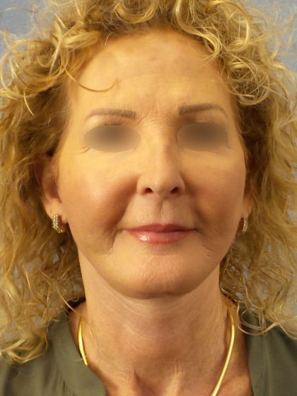Facelift Before & After Patient #891