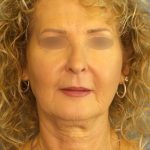 Facelift Before & After Patient #891